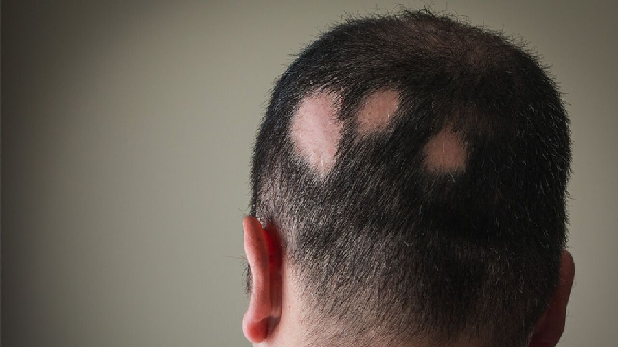 What Is Alopecia Areata? Possible Causes And Symptoms