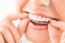 Ceramic Braces: Always Effective Without The Glory of Invisalign