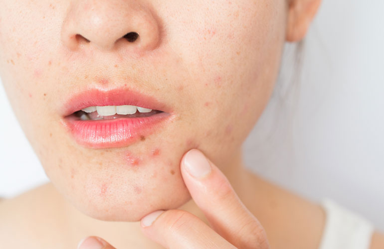 Most effective acne scar removal treatments that really work  