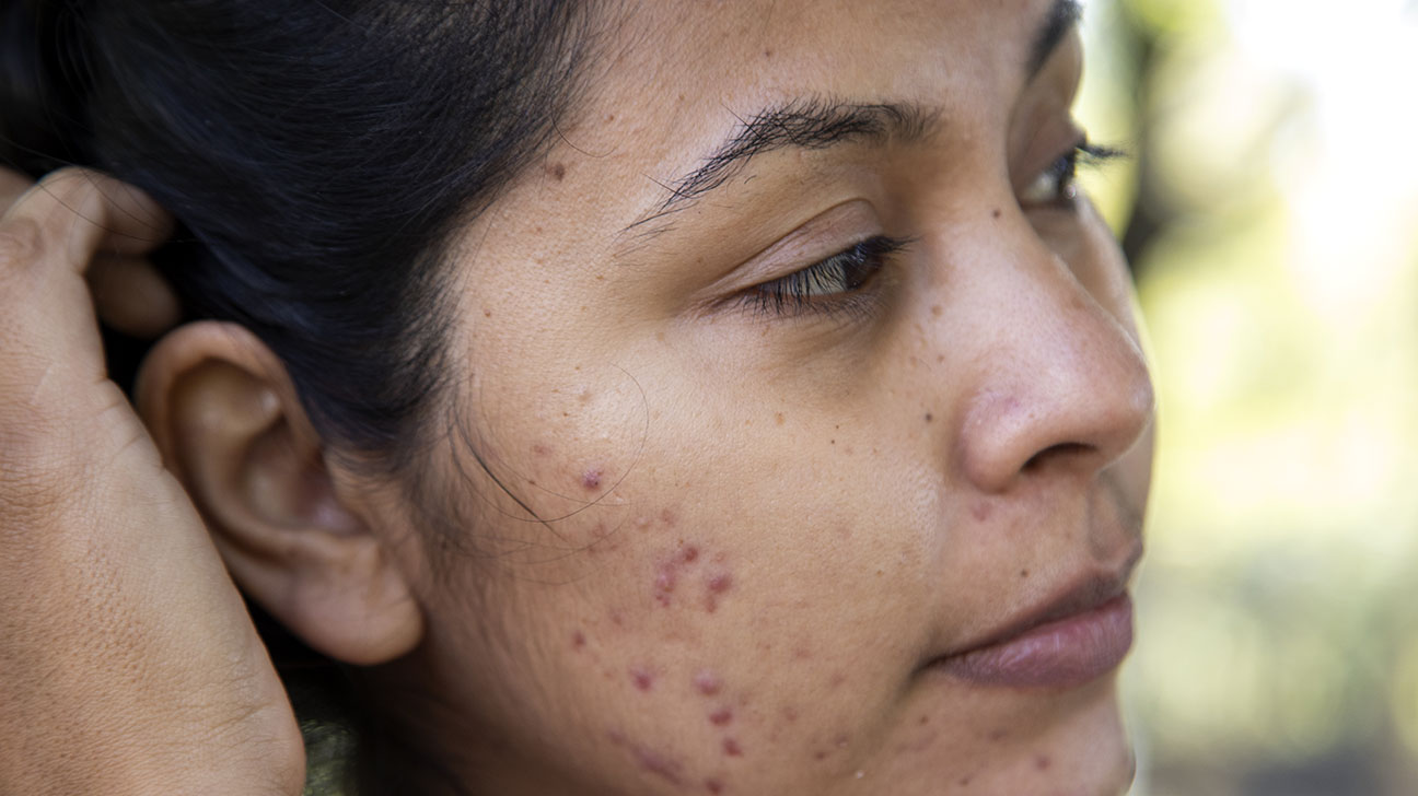 How To Treat Acne Scars In 3 Days