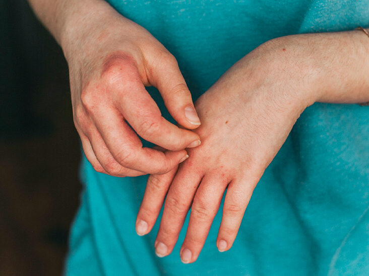 Is it necessary to know the cause of skin eczema?