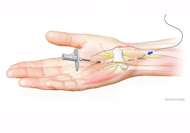 Know about what is Carpal Tunnel Syndrome