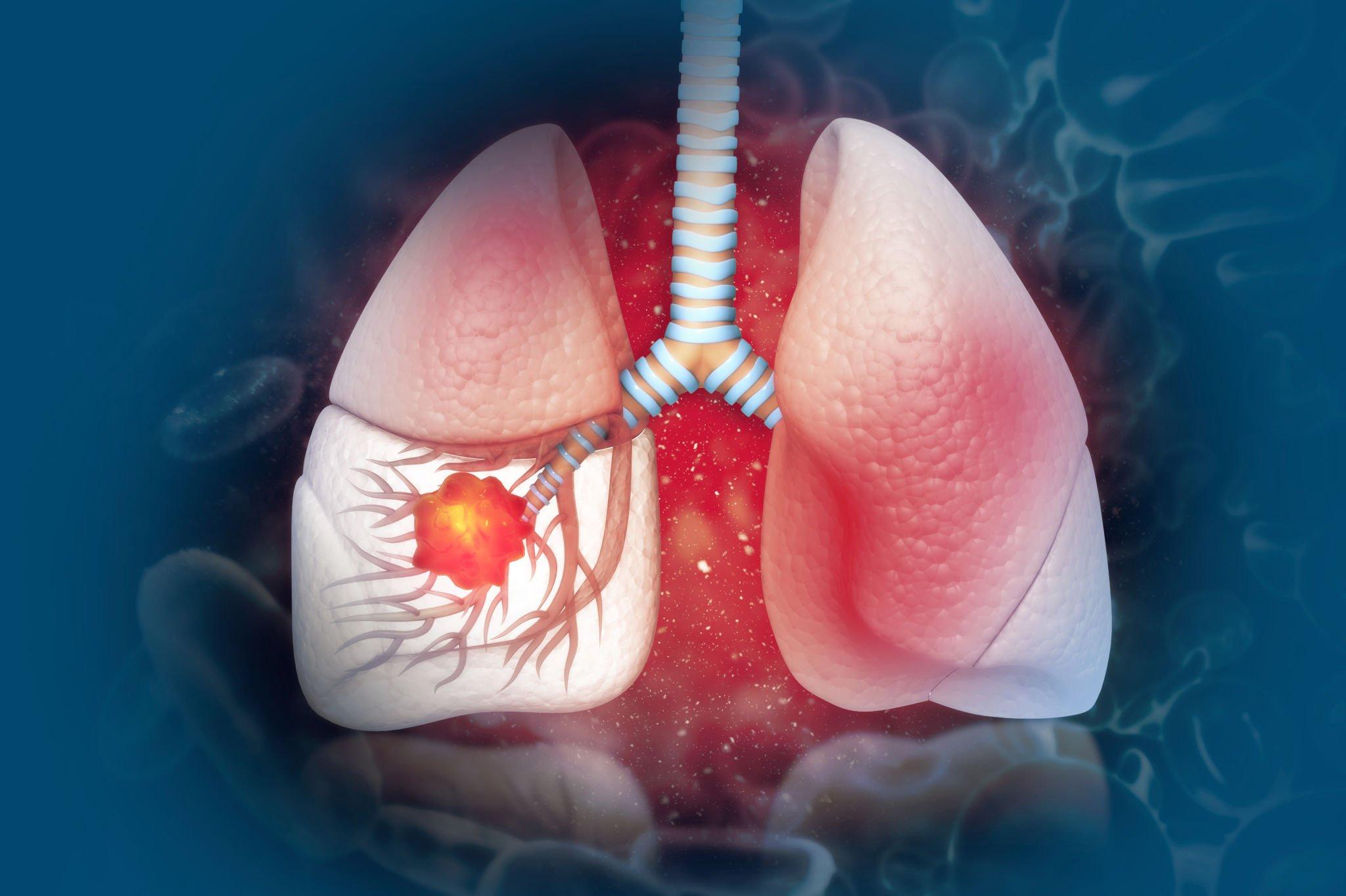 Lung Disease and its Warning Signs
